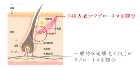 バルジ領域　IPLとTHR　アプローチ部分の違い　図解